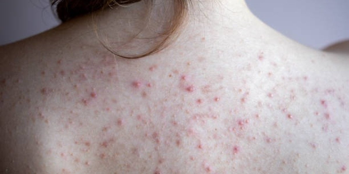 Expert Tips: How to Treat Back Acne and Neutralize Its Harmful Effects
