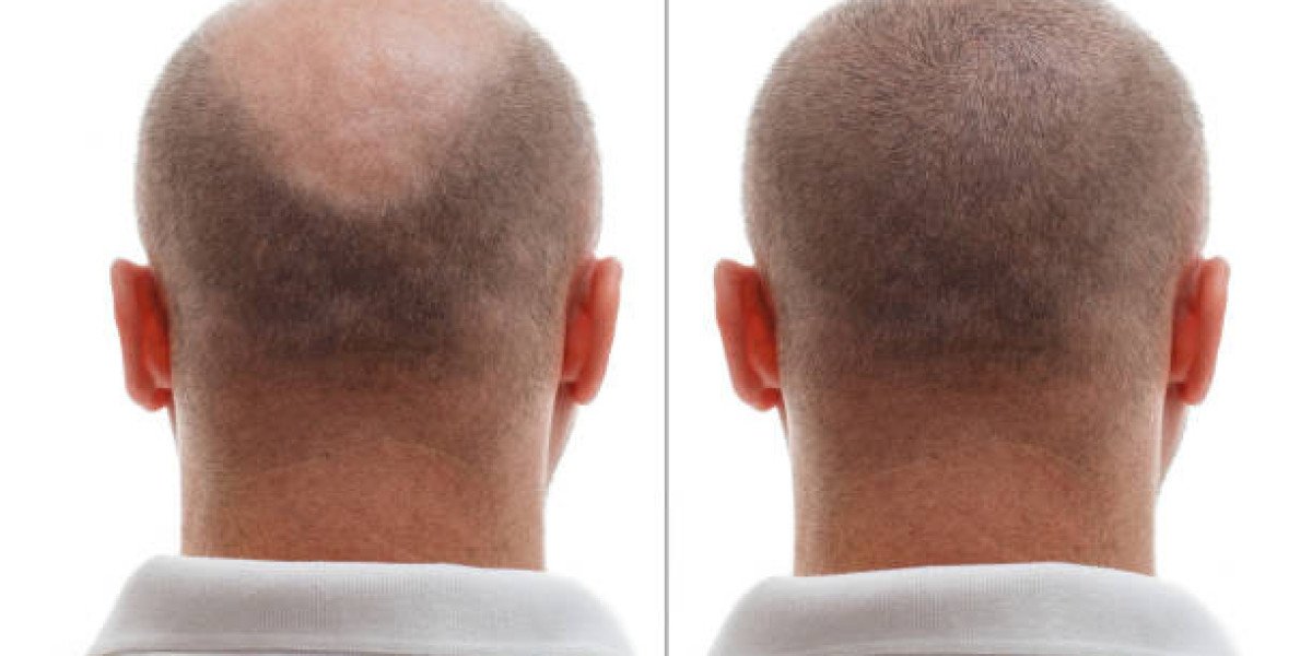 Hair Transplant Innovations in Hair Restoration Industry