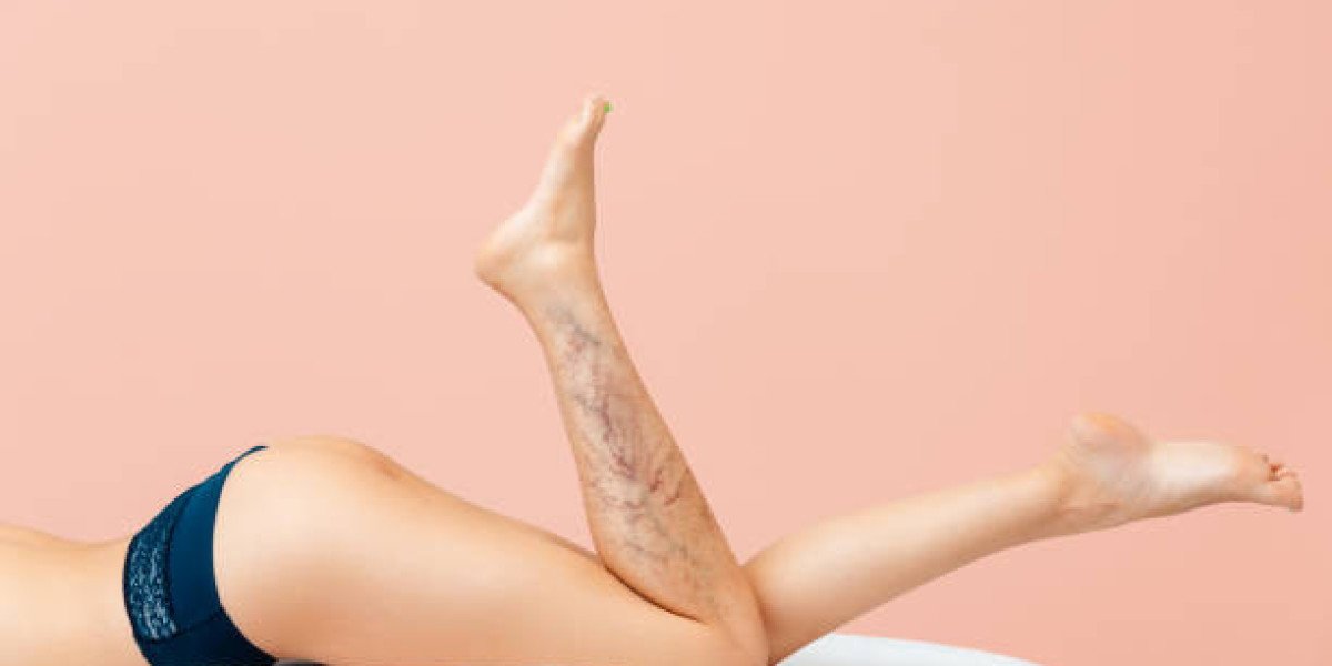 Discover Safe Varicose Veins Treatment Techniques