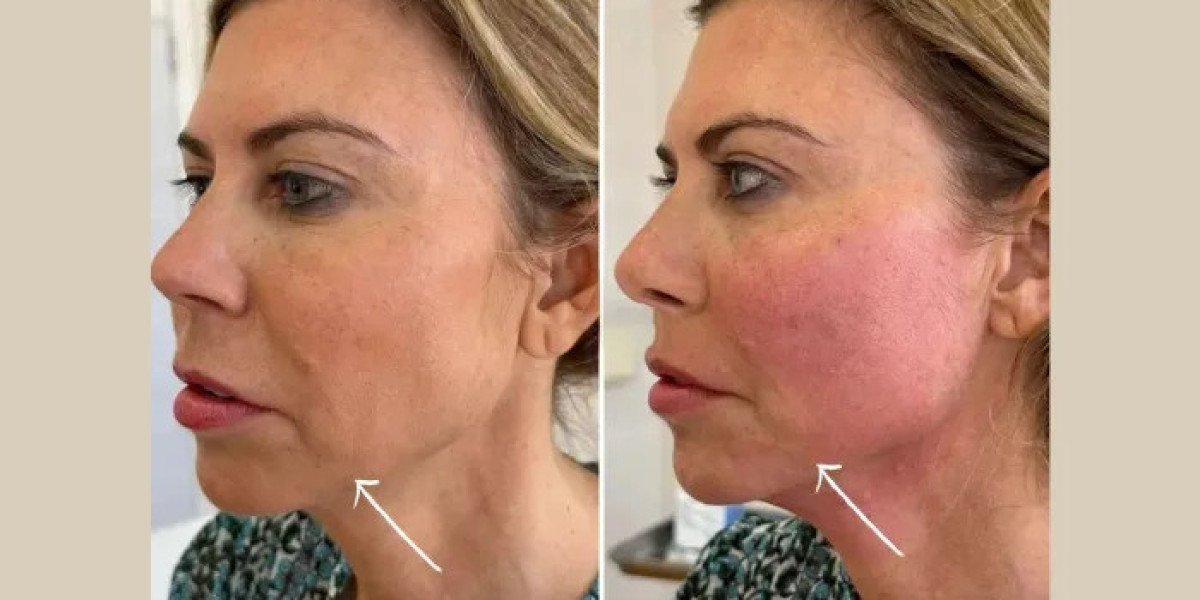 Endolift in Dubai for Non-Surgical Face and Neck Lifting