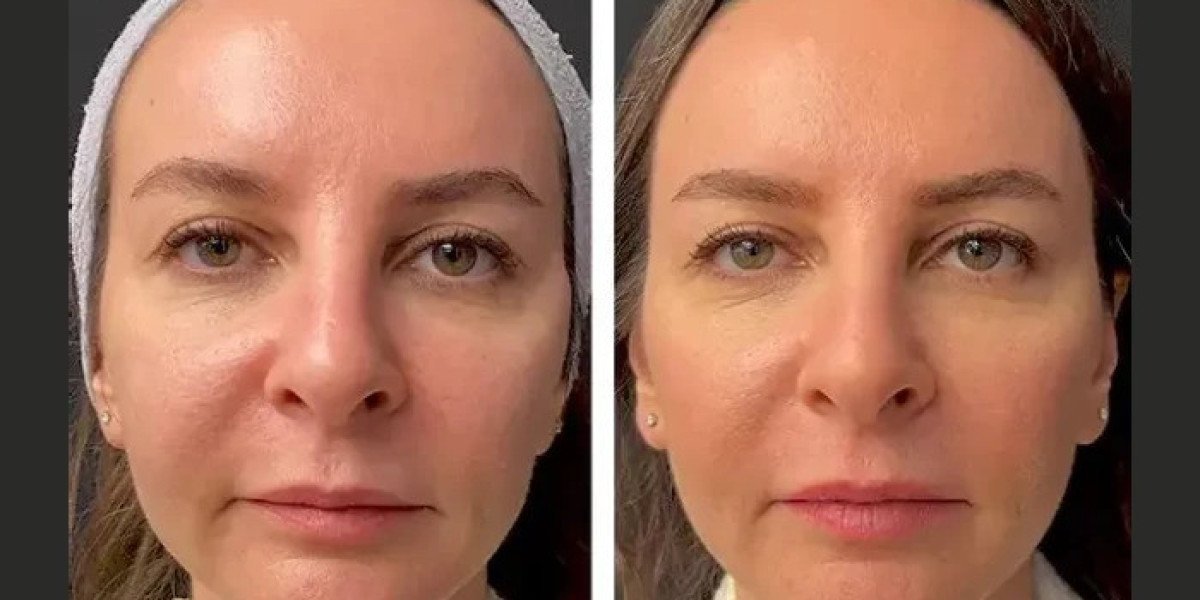 Is Mesotherapy Treatment in Dubai Safe? Risks, Benefits, and Recovery