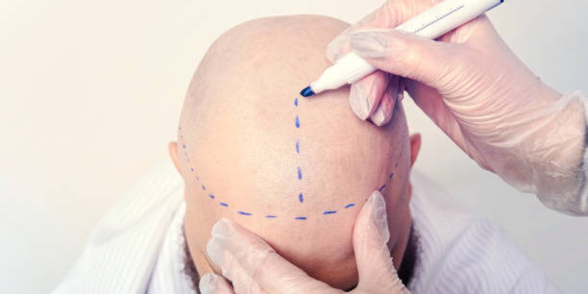 How Graft Survival Rates Affect Hair Transplant Cost Value