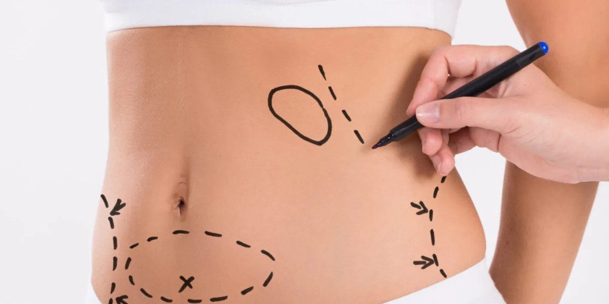 Liposuction in Islamabad and What to Expect During Consultation
