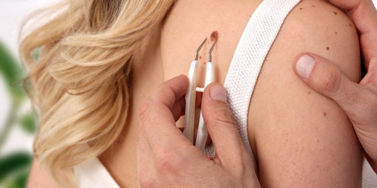 Understanding Minimal Downtime Procedures for Mole Removal in Islamabad