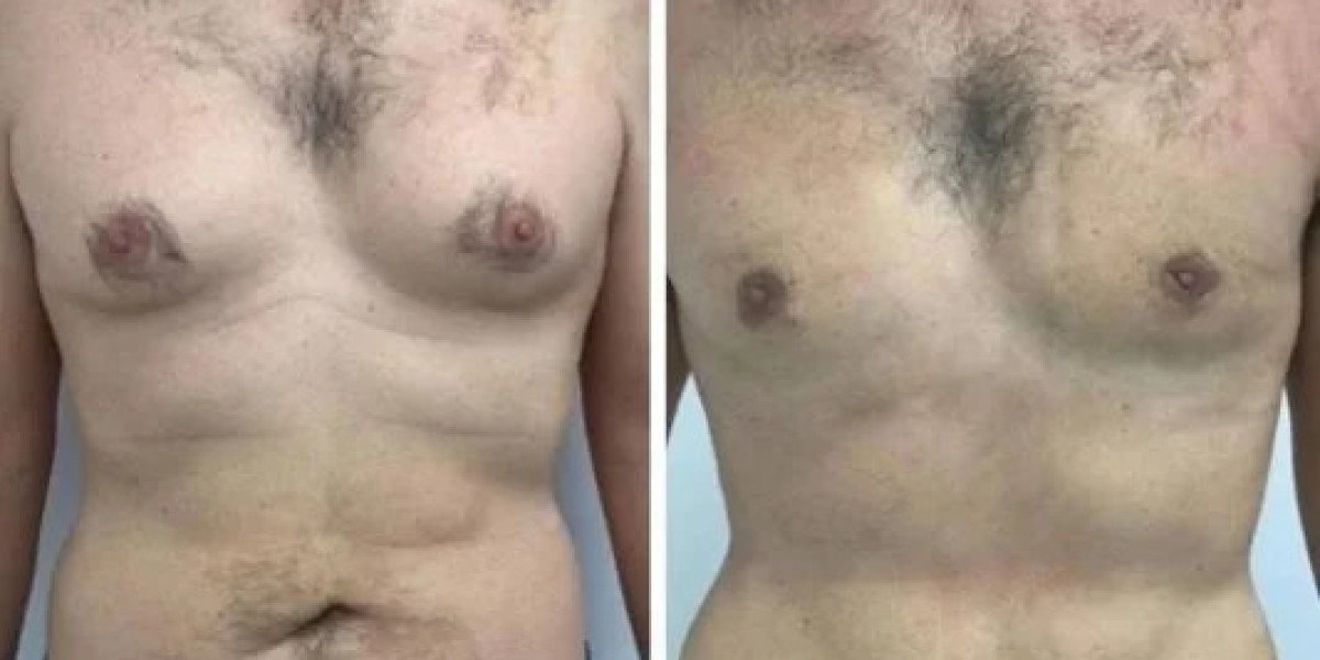 Gynecomastia in Dubai: Everything You Need to Know About Achieving a Masculine Chest Shape
