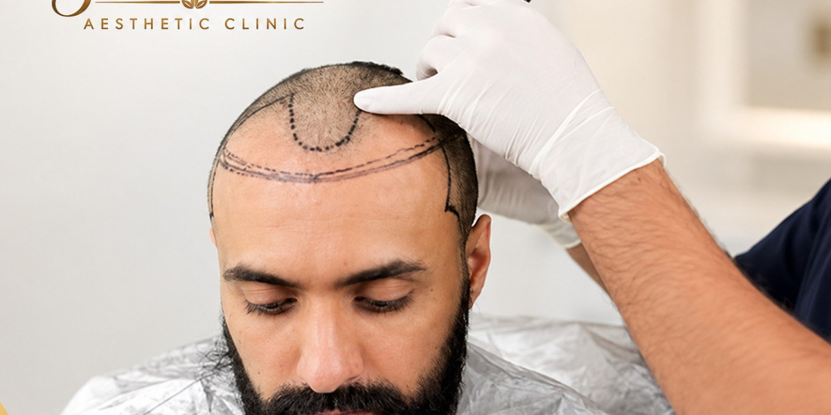 Is Bleeding Normal After a Hair Transplant?