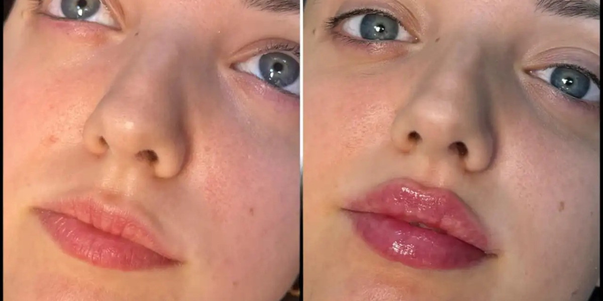 Best Aesthetic Clinic in dubai for Youth Restoring Dermal Fillers